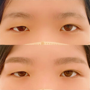 眉毛の施術イメージ